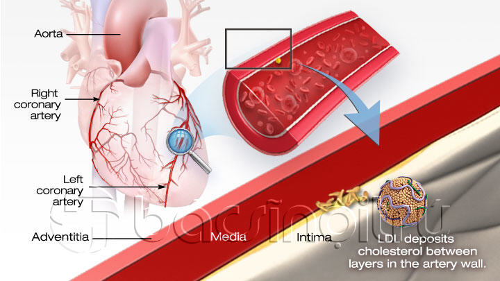 Cholesterol và bệnh động mạch vành